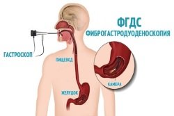Fibrogastroduedonoskopija
