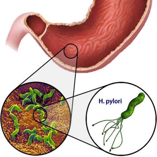 HelicobacterPylori-inficirovanie