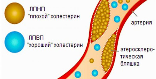 Плохой и хороший холестерин