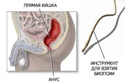 Instrument-dlja-vzjatija-biopsii