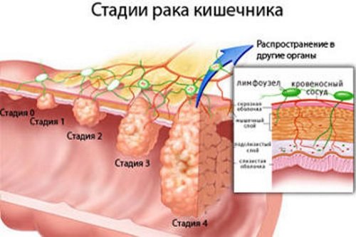 Kak-proverit-kishechnik-na-onkologiju