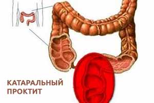 Катаральный проктит