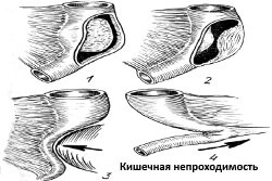 Kishechnaja-neprohodimost-vidy