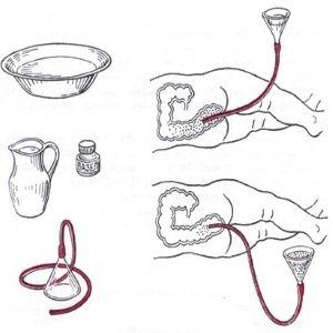 Klizma-v-domashnih-uslovijah