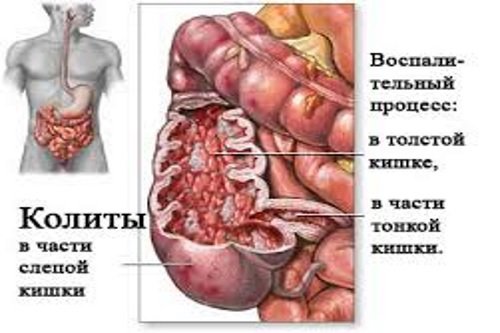 Kolit-slepoj-kishki