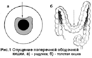 Птоз ободочной кишки