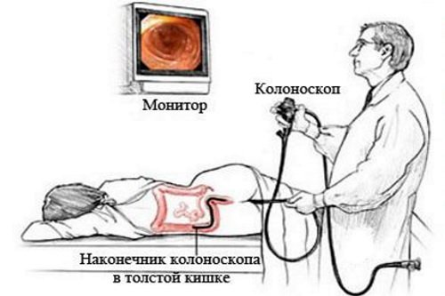Kolonoskopija-kishechnika