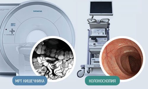 МРТ кишечника и колоноскопия