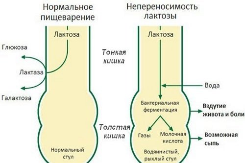 Neperenosimost-laktozy