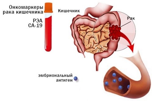 Onkomarkery-kishechnika