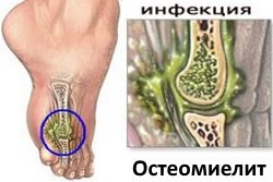 Osteomielit