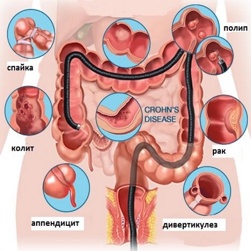 Patologii-vyjavljaemye-pri-kolonoskopii