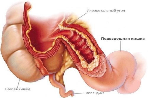 Podvzdoshnaja-kishka