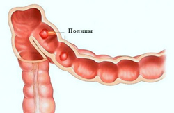 Полипоз кишечника