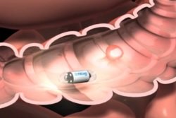 Provedenie-kapsulnoj-jendoskopii
