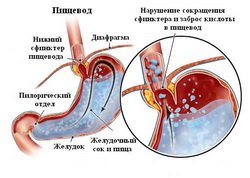 Refljuks-zheludka-iz-za-bulimi