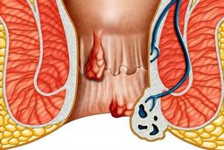 Доброкачественные заболевания прямой кишки