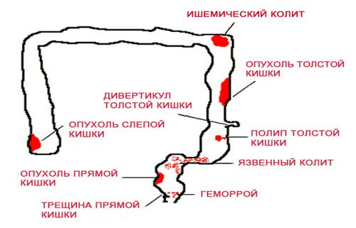 Скрытая кровь в кале - причины