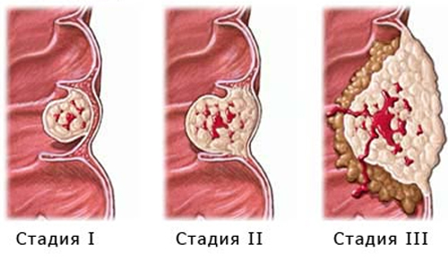 Стадии рака