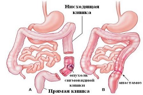 Udalenie-opuholi-sigmovidnoj-kishki