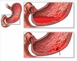 Кровотечение желудка