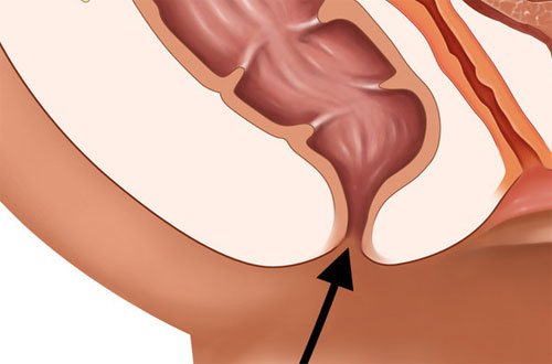 недостаточность анального сфинктера