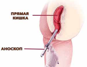 Диагностика проктита