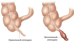 Воспаление аппендикса