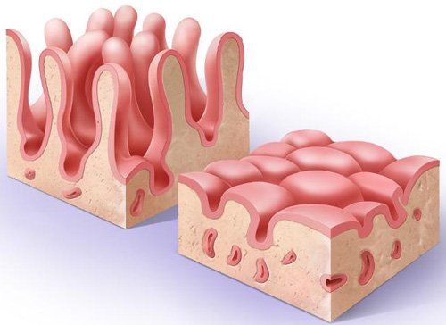 Атрофия ворсин кишечника