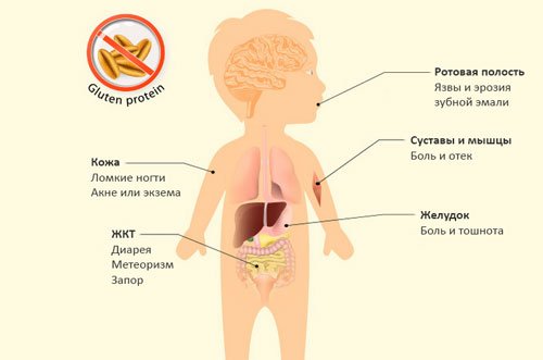 Симптомы целиакии у ребенка