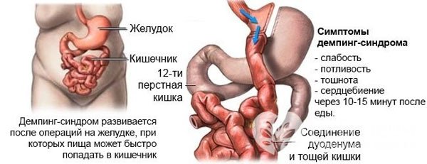 Демпинг синдром