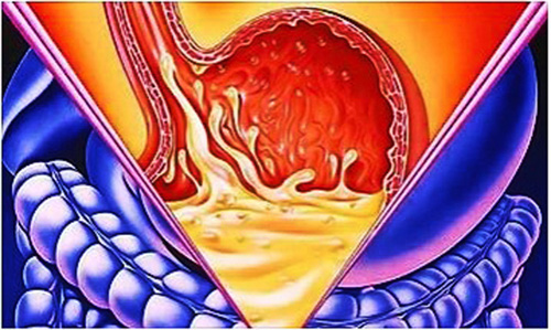 Функциональная диспепсия