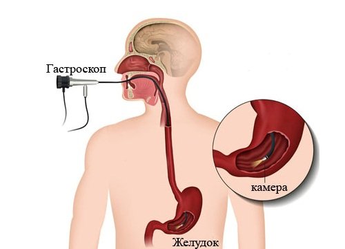 Гастроскопия