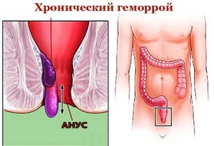 Хронический геморрой