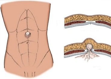 Грыжа передней брюшной стенки живота