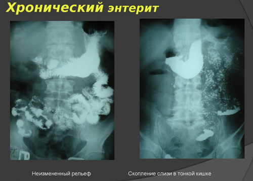 Хронический энтерит