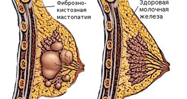 Как выглядит мастопатия схематично