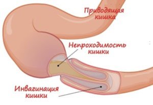 Острая непроходимость