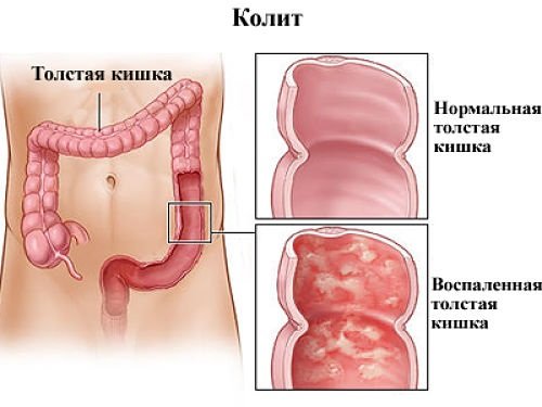 kolit-kishechnika