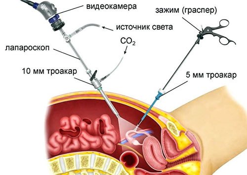 Лапаросхема