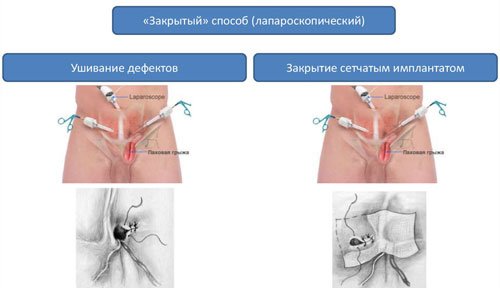 Хирургия грыж