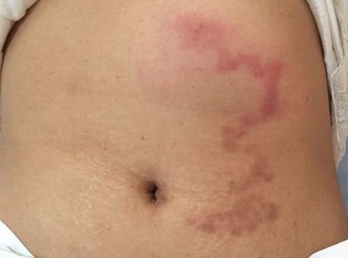 Мезентериальный панникулит