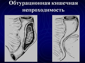 Обтурационная непроходимость