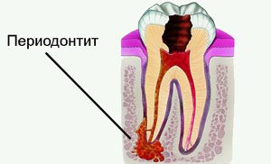 Периодонтит