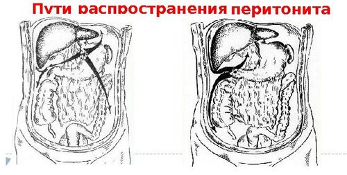 Перитонит