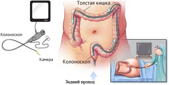 Мегаколон: причины, симптомы и лечение (диета, медикаменты, хирургия)