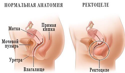 Ректоцеле