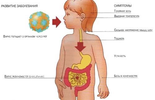 simptomy-kishechnogo-grippa-u-detey