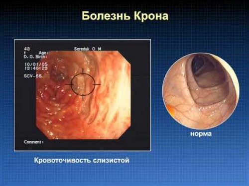 Слизь в кишечнике: почему появляется и как лечить патологию?