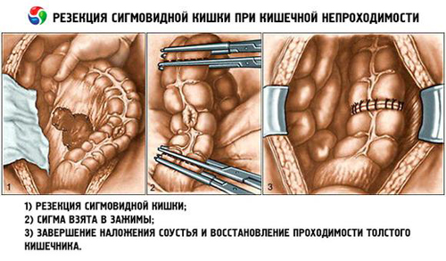 Резекция участка кишечника